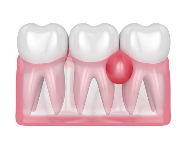 Điều trị áp xe răng như thế nào?