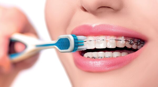 Các bước chải răng hiệu quả