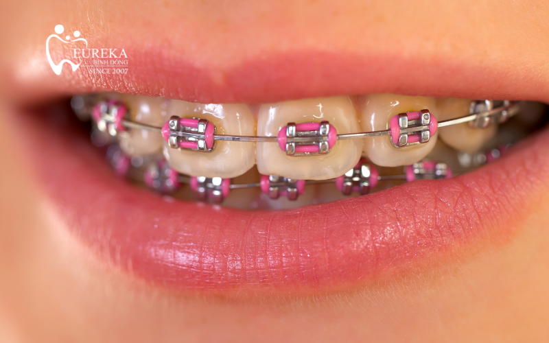 Niềng răng phía trong và những vấn đề bạn cần nắm rõ trước khi niềng