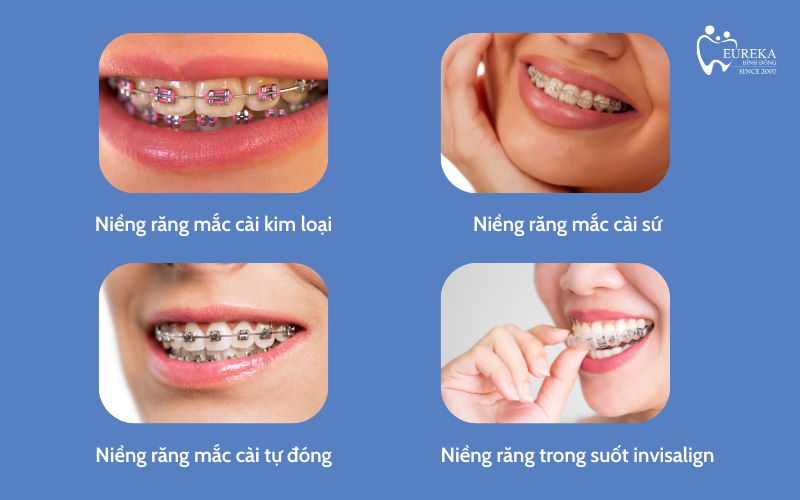 Các phương pháp niềng răng hiện nay