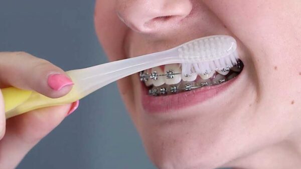 Chăm sóc răng miệng khi đeo niềng răng