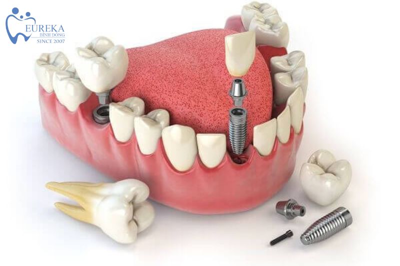 Răng Implant có thể giải quyết những vấn đề nào?
