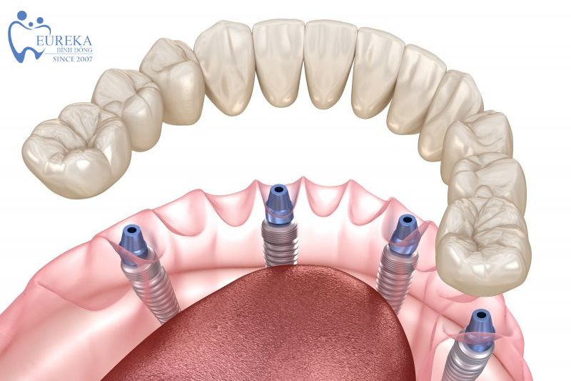 Thời gian cấy ghép Implant on all 4
