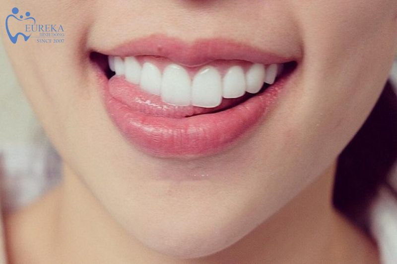 Một số lưu ý khi lựa chọn niềng răng Invisalign