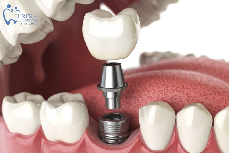 Trồng răng Implant là phương pháp thay thế răng mất tiến bộ nhất của ngành Nha Khoa