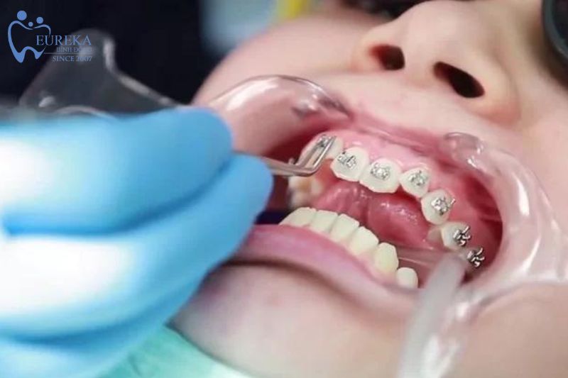 Niềng răng là phương pháp khắc phục tình trạng hô móm