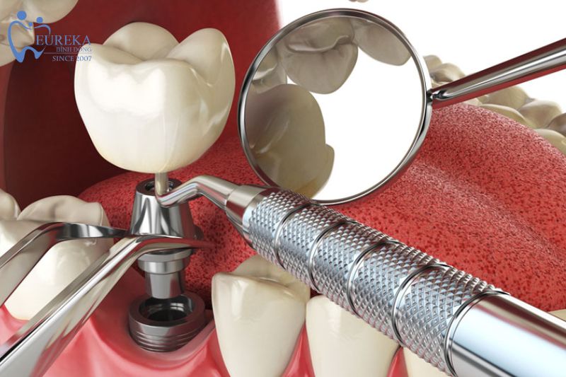 Trồng răng Implant là một phương pháp xử lý mất răng hiện đại