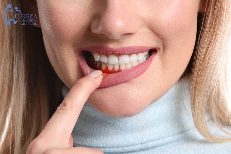 Quy trình 5 bước trồng răng Implant tại nha khoa Eureka
