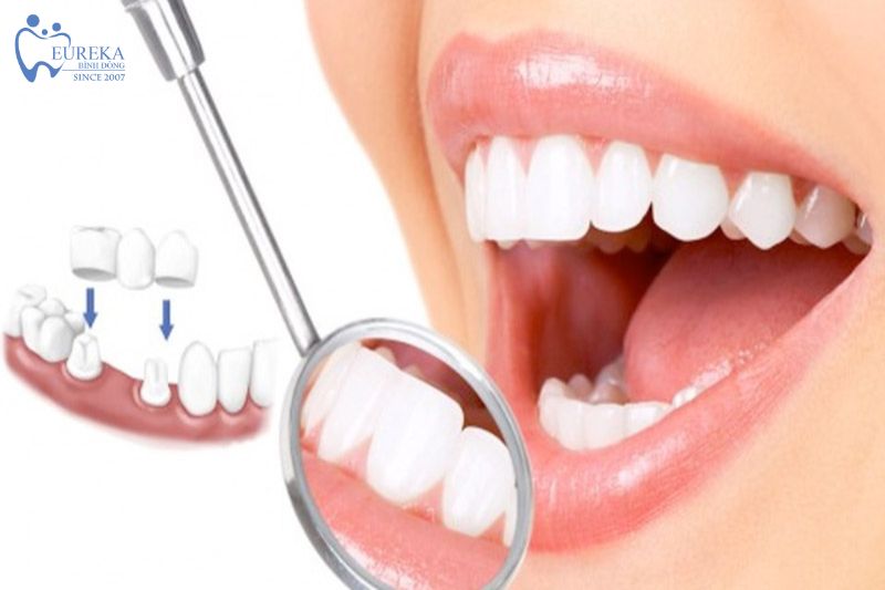 Nhược điểm của răng sứ thẩm mỹ