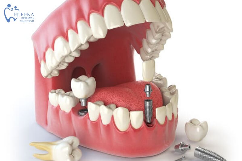 Quy trình cấy ghép implant tại nha khoa Eureka Bình Đông