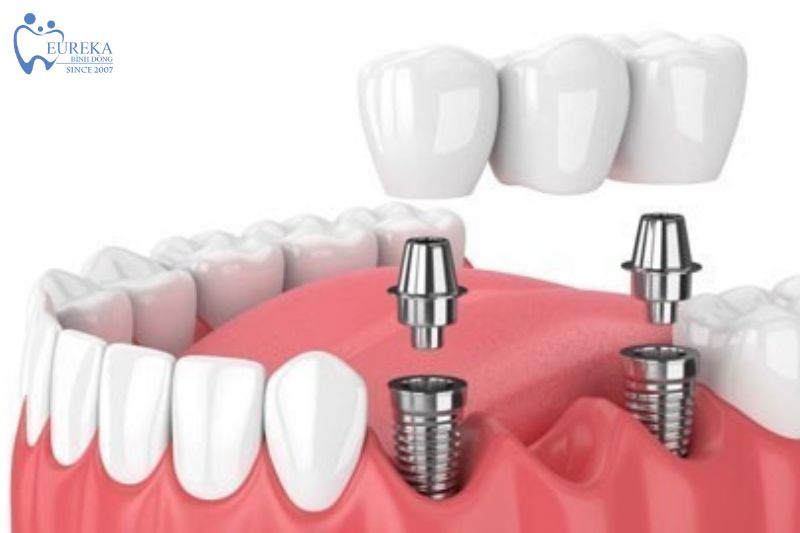 Dịch vụ cấy ghép implant tại nha khoa Eureka Bình Đông