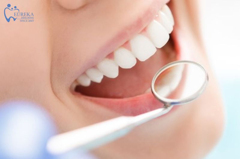 Dịch vụ làm sạch răng tại Nha khoa Eureka Bình Đông