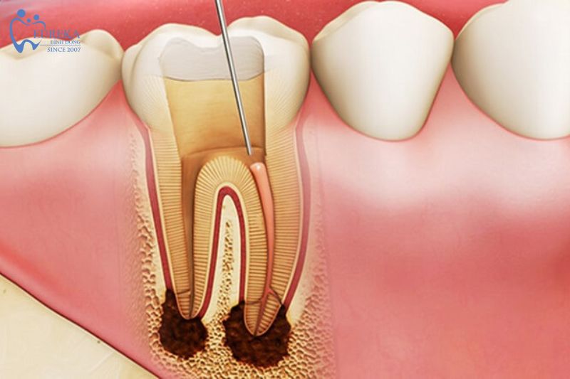 Quy trình thực hiện điều trị tủy răng