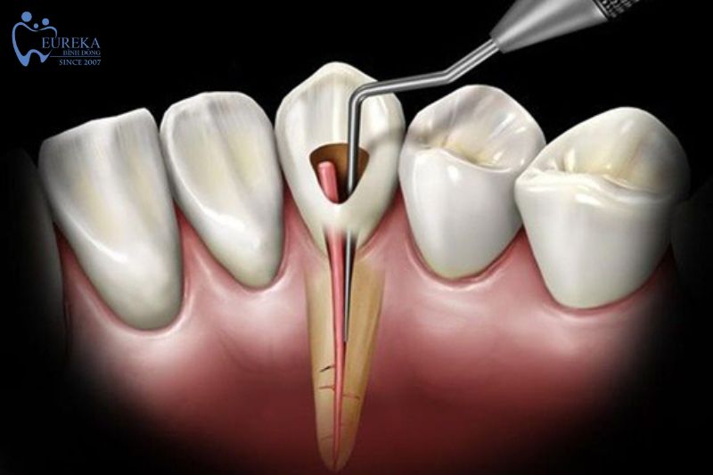 Thời gian điều trị tủy bao lâu?