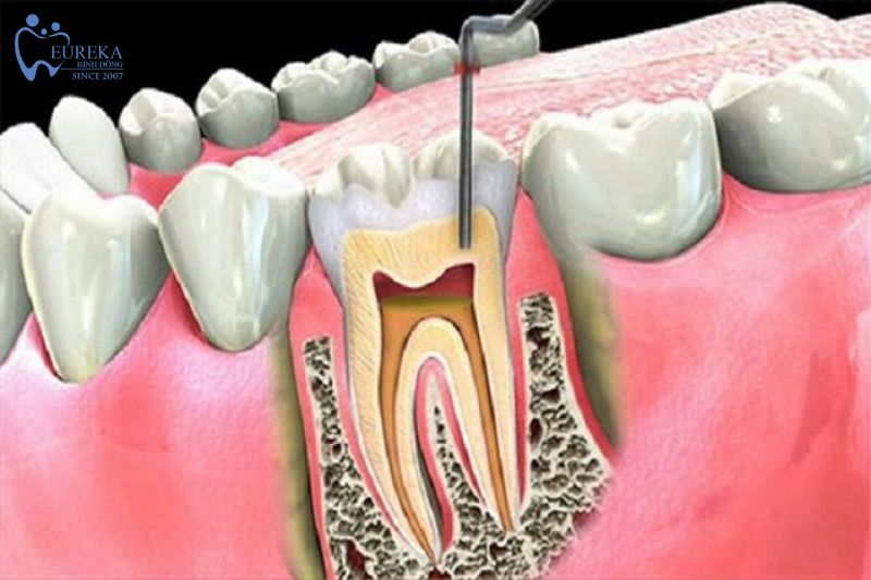 Phương pháp nội nha tại nha khoa Eureka Bình Đông