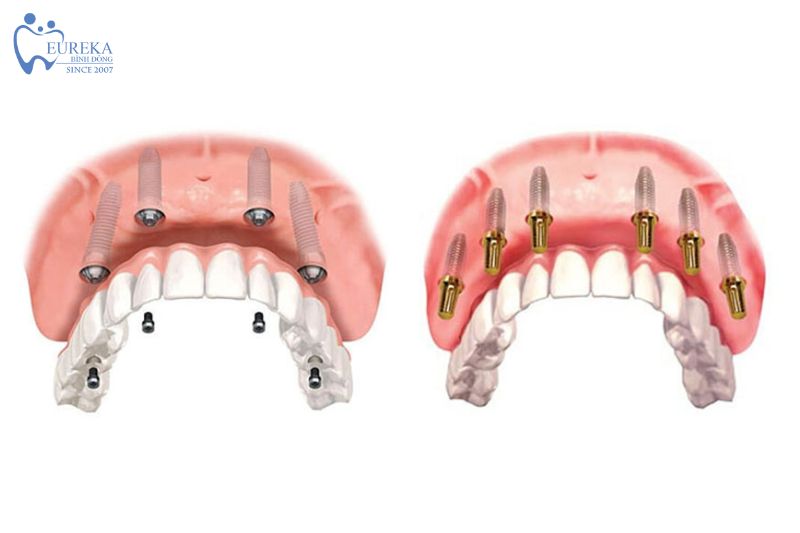 Thời gian cấy ghép implant All on X