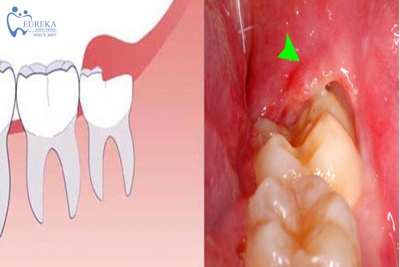 Quy trình nhổ răng khôn tại nha khoa Eureka Bình Đông