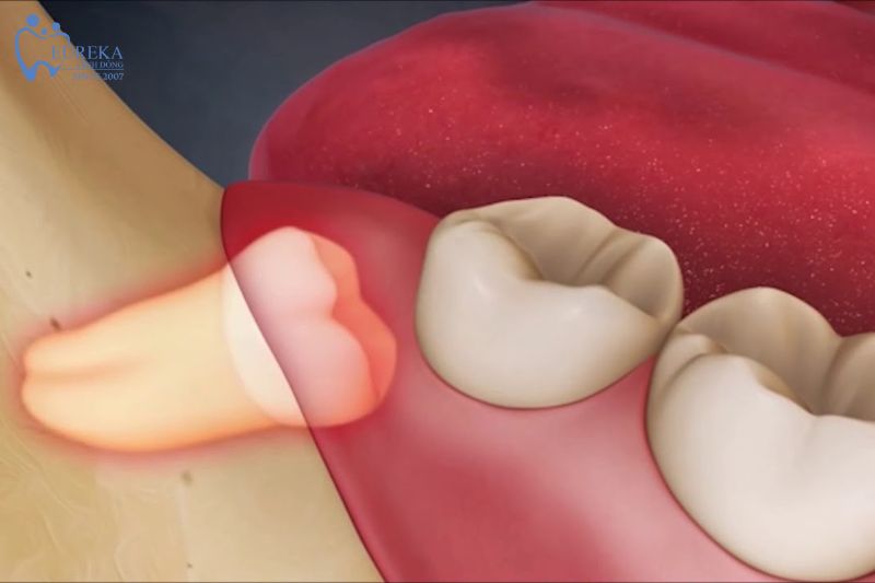 Quý trình chuẩn bị nhổ răng cần làm gì?