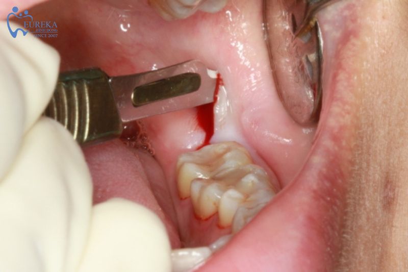 Những trường hợp cần được nhổ răng