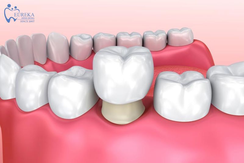 Những chú ý đến việc chăm sóc răng miệng sau khi bọc răng sứ