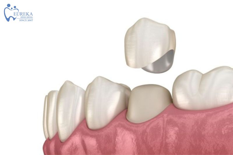 Các phương pháp bọc răng sứ thẩm mỹ