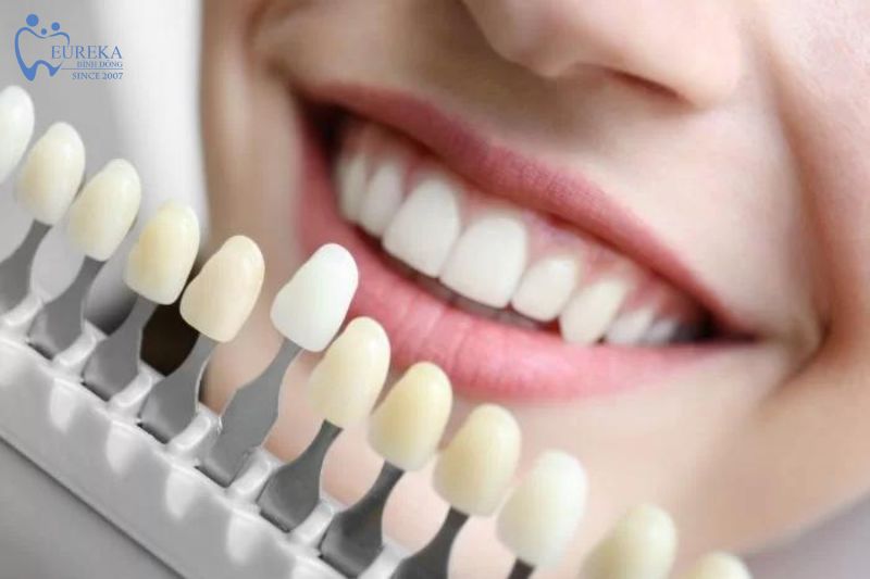 Những đối tượng nào nên bọc răng sứ thẩm mỹ
