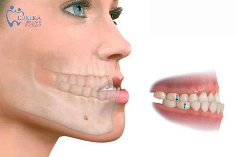 Quy trình niềng răng kết hợp với phẫu thuật hàm mặt