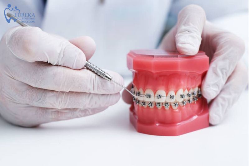 Dịch vụ niềng răng tại Nha khoa Eureka