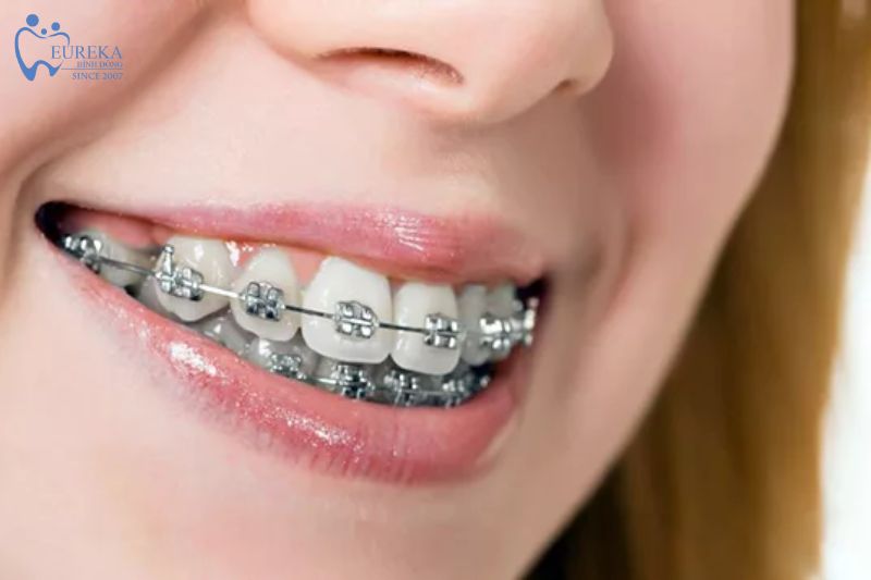 Những lưu ý để niềng răng hiệu quả nhất