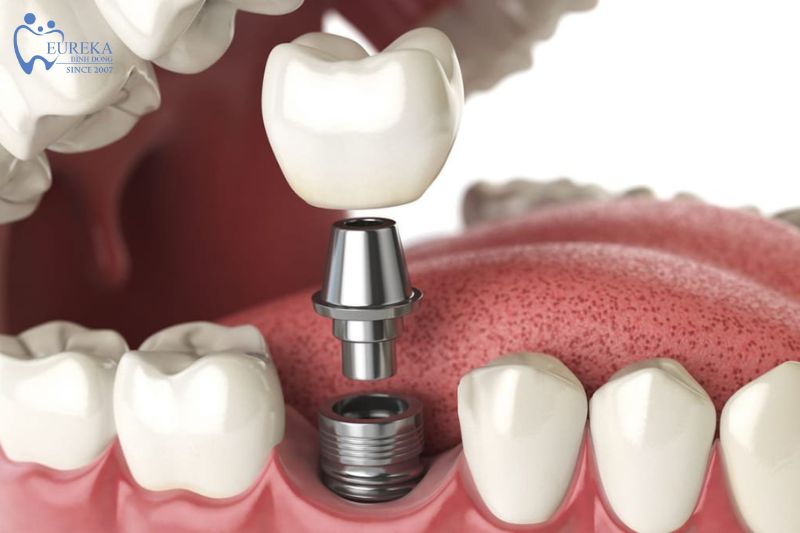 Cấy ghép implant giúp bạn ăn nhai tốt hơn