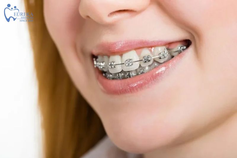 Niềng răng mắc cài kim loại là gì?