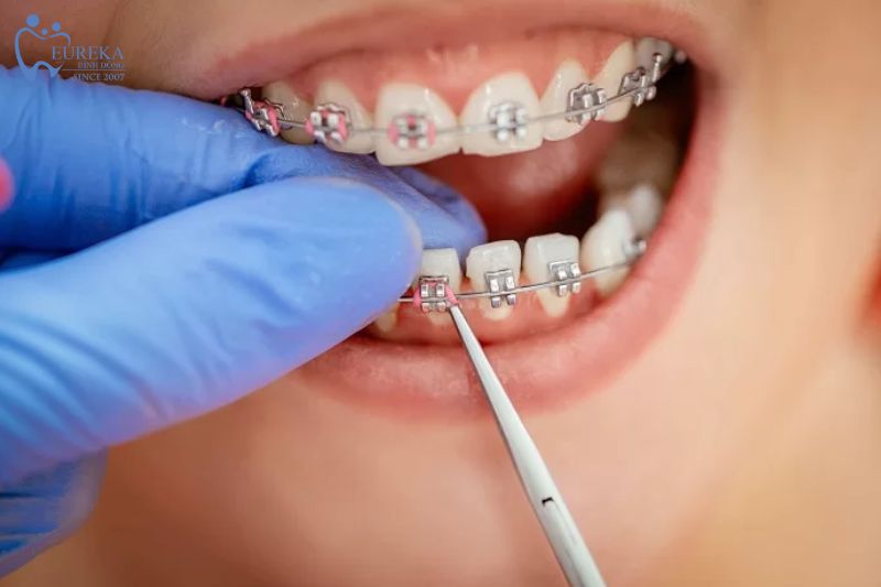 Tại sao niềng răng mắc cài kim loại lại được nhiều người lựa chọn