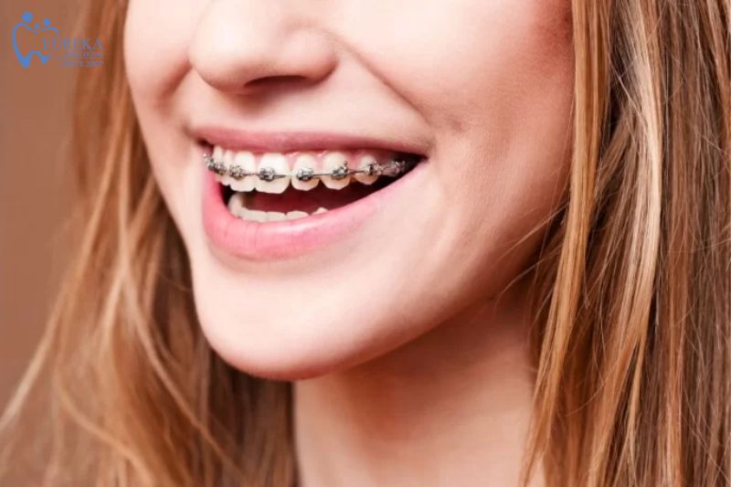Ưu và nhược điểm của niềng răng mắc cài kim loại