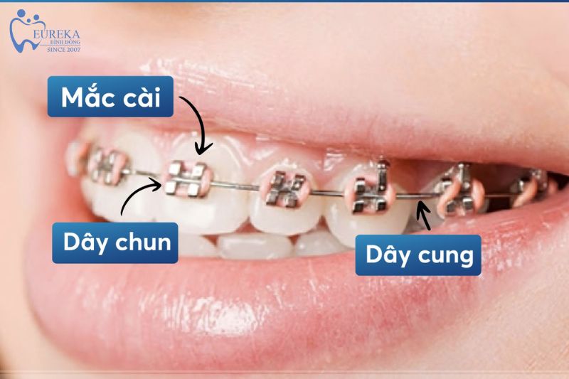 Niềng răng kim loại phù hợp với ai?
