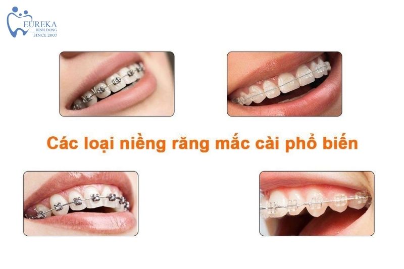 Các loại niềng răng mắc cài phổ biến hiện nay