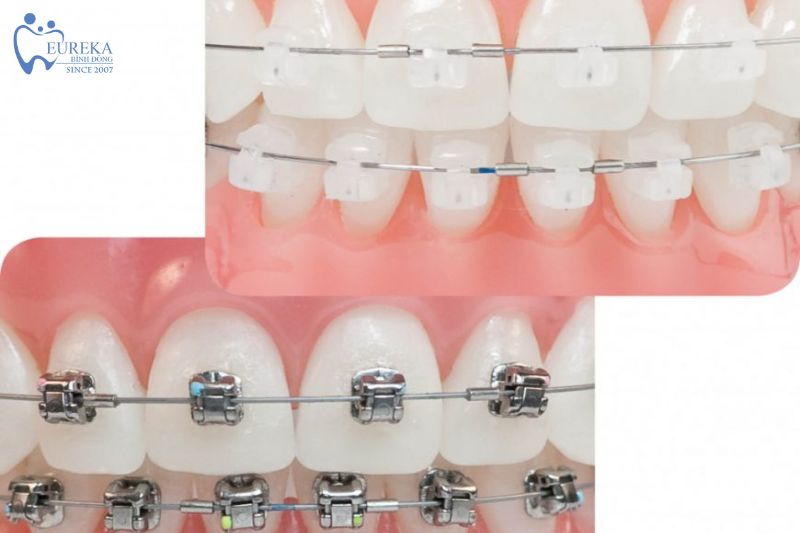 Yếu tố cần xem xét khi chọn niềng răng mắc cài kim loại