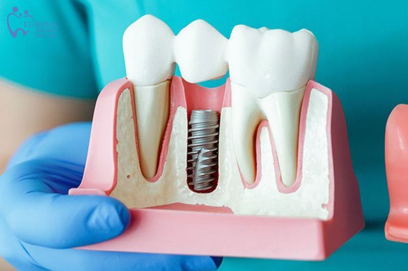 Ưu điểm của cấy ghép implant