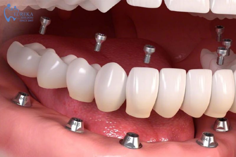 Điều kiện để cấy ghép implant thành công