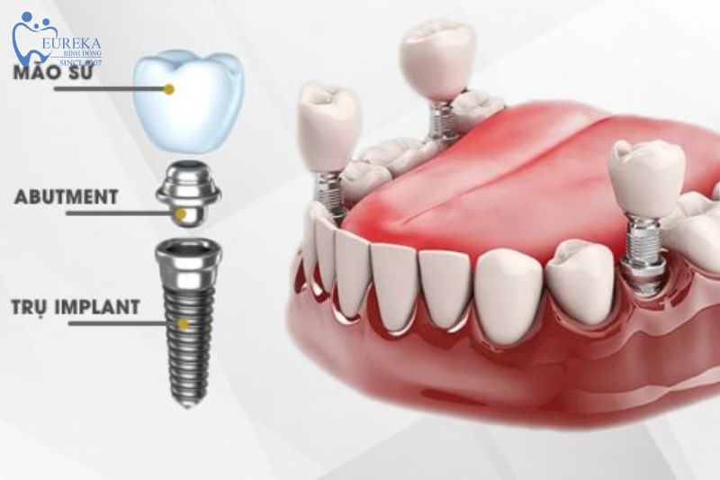 Cấy ghép implant là gì?