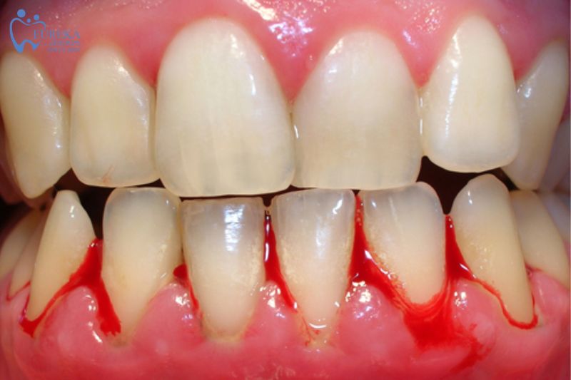 Triệu chứng của viêm lợi