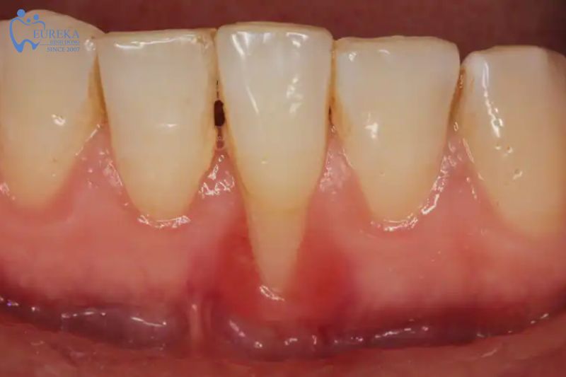 Cách phòng ngừa viêm lợi hiệu quả