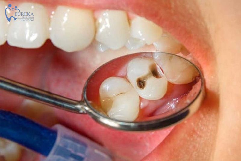 Tại sao bị sâu răng lại gây đau nhức?