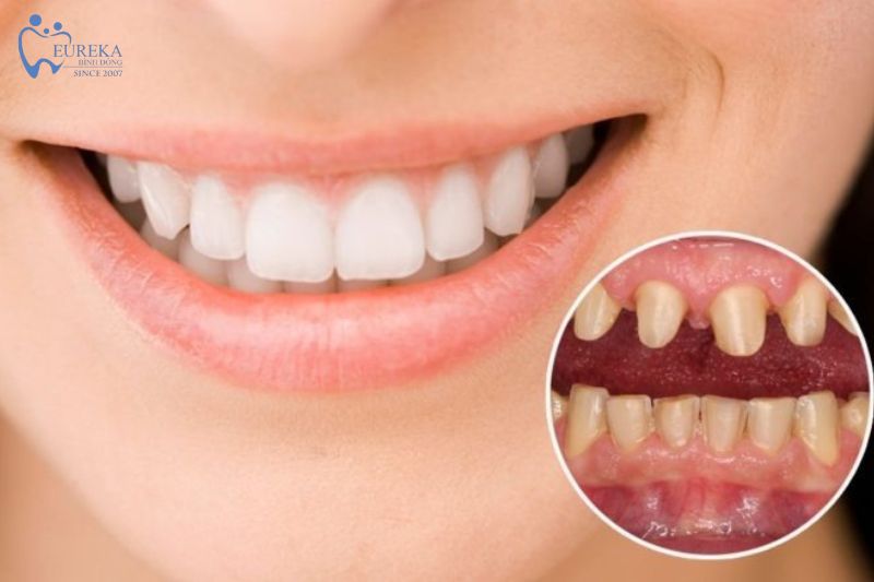 Tại sao bị đau sau khi bọc răng sứ?