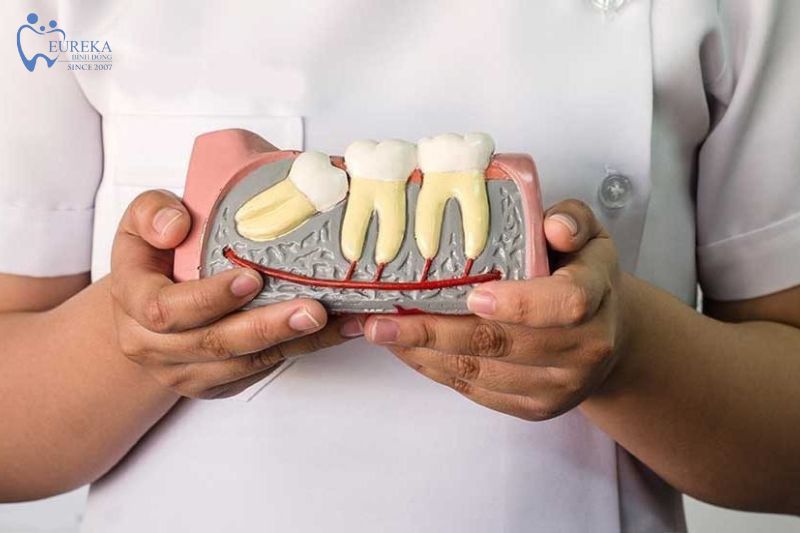 Quy trình phẫu thuật răng khôn chi tiết tại Nha khoa Eureka