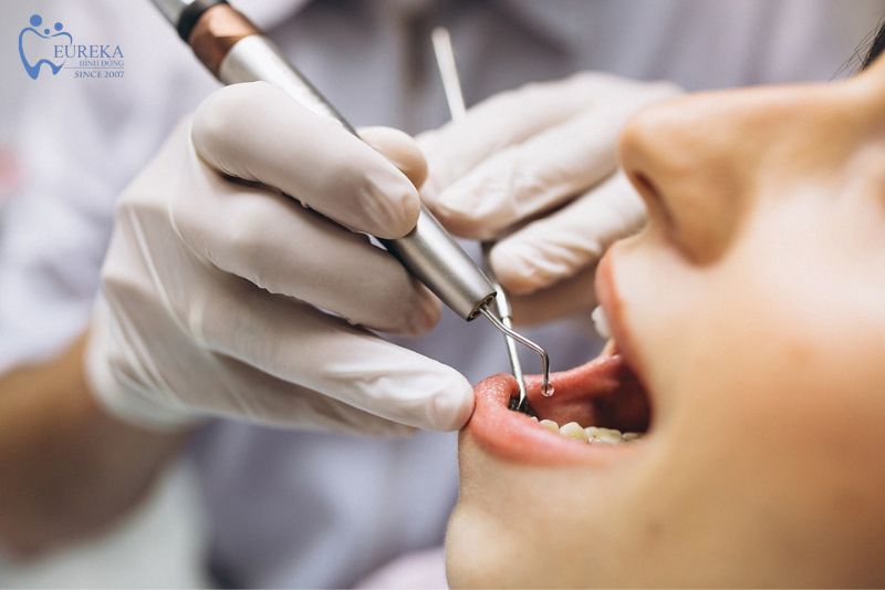 Tại sao nên phẫu thuật răng khôn tại Nha khoa Eureka?