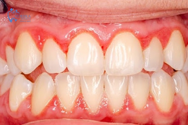 Cách chăm sóc răng miệng khi bị tụt nướu răng
