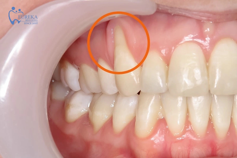 Nguyên nhân gây ra tụt nướu răng