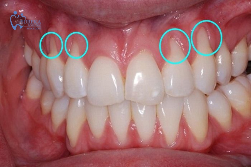Tụt nướu răng có phục hồi được không?