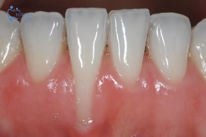 Triệu chứng của hiện tượng tụt nướu răng