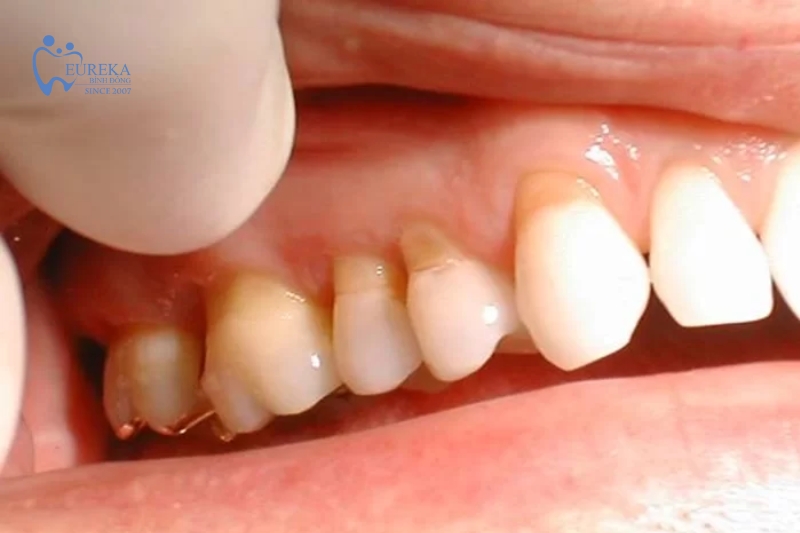 Nguyên nhân của hiện tượng tụt nướu răng